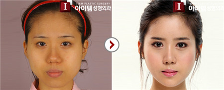 韩国爱婷面部轮廓对比