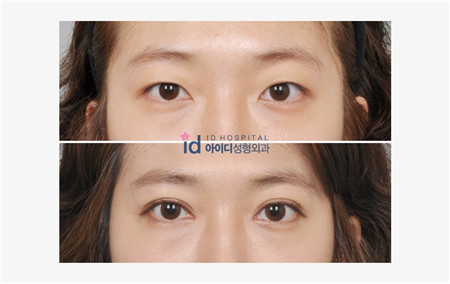 韩国ID双眼皮案例对比