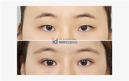 韩国ID双眼皮整形对比案例