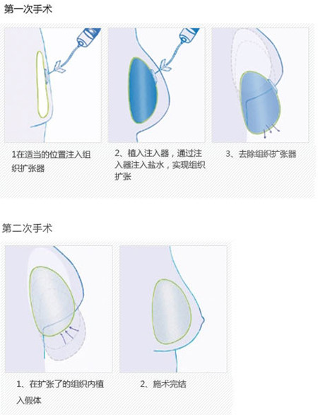 韩国原辰乳房重建手术示意图