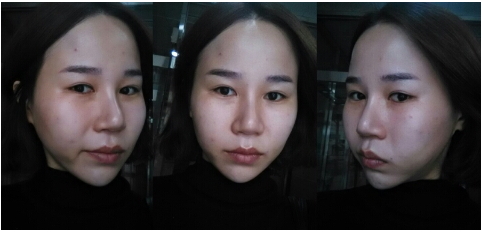 韩国巴诺巴奇皮肤水光针治疗过程