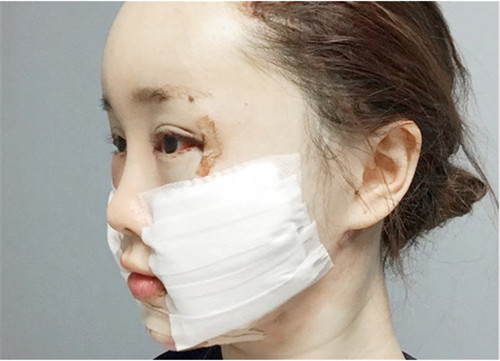 韩国芙莱思面部吸脂手术日记术后第一天