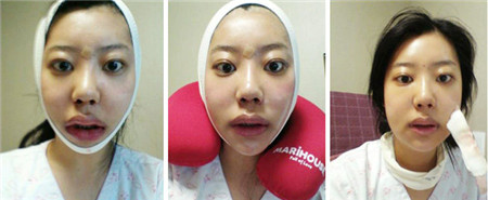 韩国面部轮廓手术恢复日记