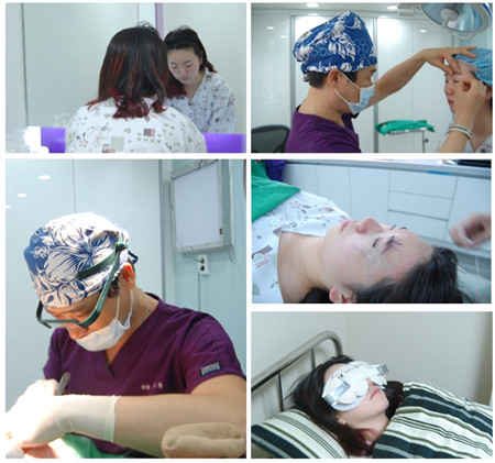 韩国双眼皮手术过程