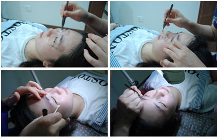 韩国双眼皮手术手术日记