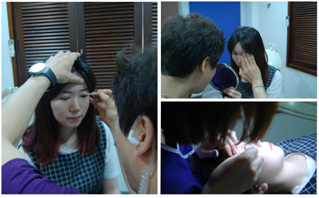 韩国双眼皮手术拆线过程