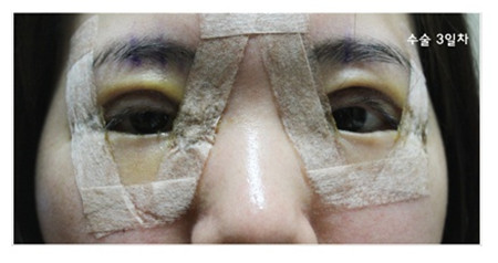 韩国清潭优双眼皮手术效果怎样？