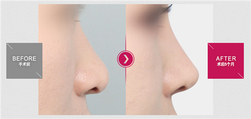 韩国DA隆鼻手术对比案例