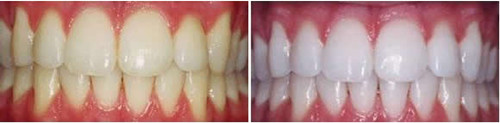 牙齿美白案例对比图 韩国龙PLANT牙科