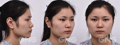 韩国GNG轮廓手术恢复日记术前照片
