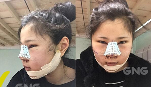 韩国GNG隆鼻手术恢复日记