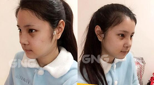 韩国GNG隆鼻手术手术恢复经历