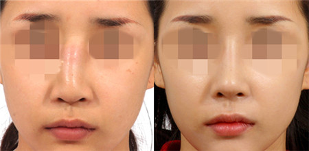 韩国假体隆鼻手术对比