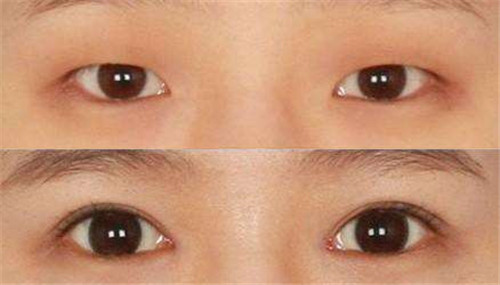 韩国双眼皮整形对比