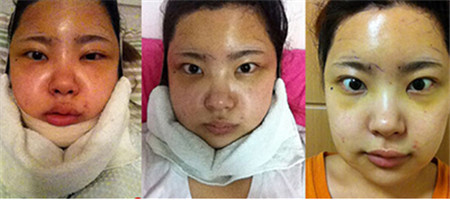 韩国脂肪填充术后照片第三天
