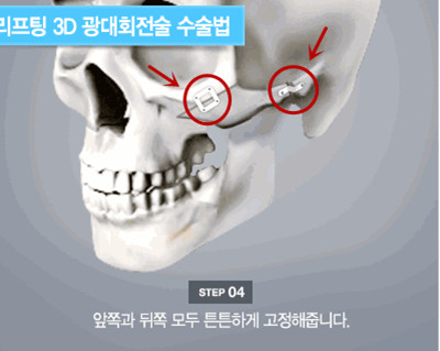 韩国颧骨整形示意图