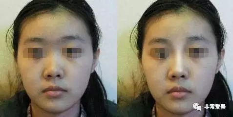 韩式生科隆鼻术前术后照