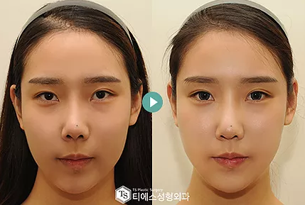 韩国TS双眼皮修复案例图片