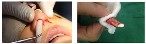 硅胶隆鼻与膨体隆鼻对比