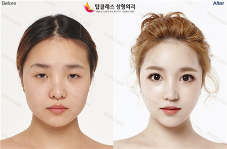韩国出色外科眼部整形对比