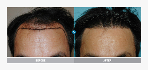 韩国毛杰琳整形医院男性毛发移植案例对比图