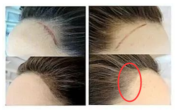 （多图）纹发际线前后对比照片
