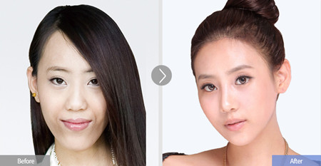 韩国faceline整形外科改脸型