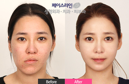 韩国faceline改脸型
