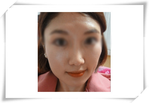 国字脸3套整形方案曝光，有一种曾风靡韩国！