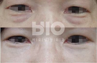 韩国BIO眼部整形对比案例