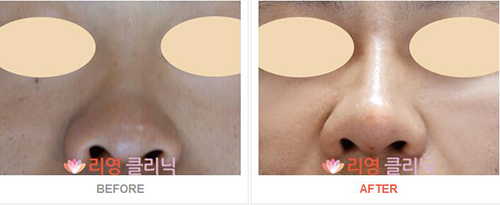 韩国丽颖整形外科玻尿酸隆鼻案例对比