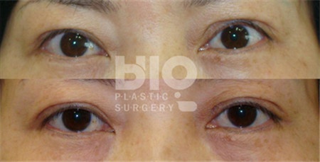 韩国BIO眼睛手术对比