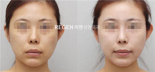 韩国丽珍整形外科医院鼻修复案例