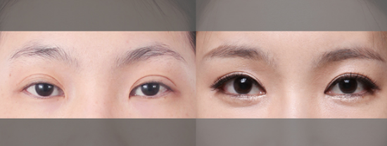 韩国眼综合整形手术前后对比图