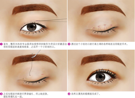 双眼皮手术过程