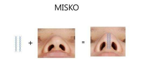 misko隆鼻手术过程