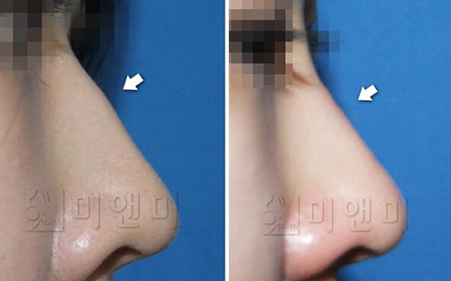 美&美微整形皮肤科鼻整形案例对比图