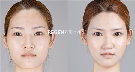 韩国丽珍下颌角整形案例