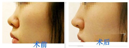 韩式膨体隆鼻前后对比图