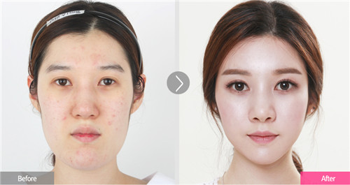 韩国faceline脂肪填充对比案例