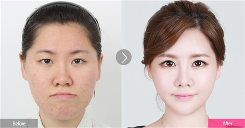 韩国faceline脂肪填充对比案例