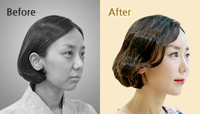 韩国黄金G整形外科皮肤科脂肪移植案例对比图