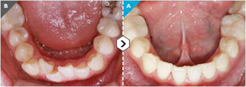 UC江南牙科牙齿矫正案例对比图