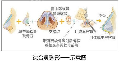 韩式鼻综合整形示意图