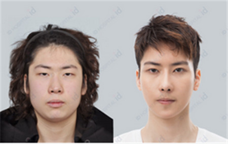 韩国ID男士下颌角整形案例