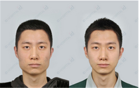 韩国ID男士下颌角整形案例
