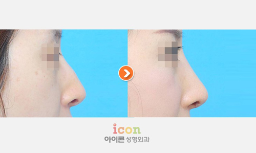 韩国ICON（图标）整形医院驼峰鼻矫正案例对比图