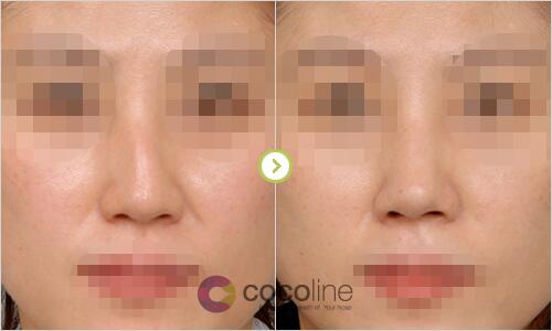 韩国Cocoline整形歪鼻矫正案例对比图