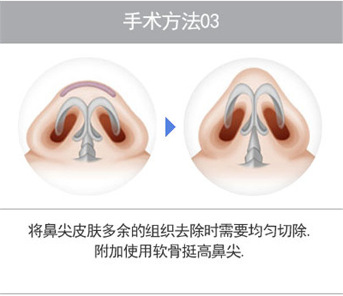 韩国丽珍鼻尖缩小手术方法