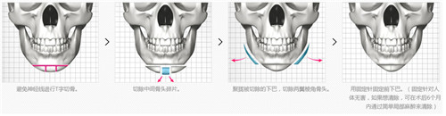 韩国下颌整形手术示意图